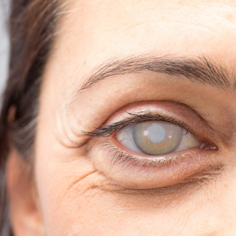 eye-adult-woman-with-cataract